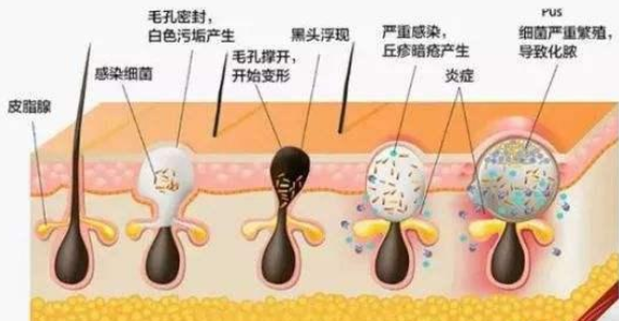 怎样提升毛孔粗大护肤品的使用效果？